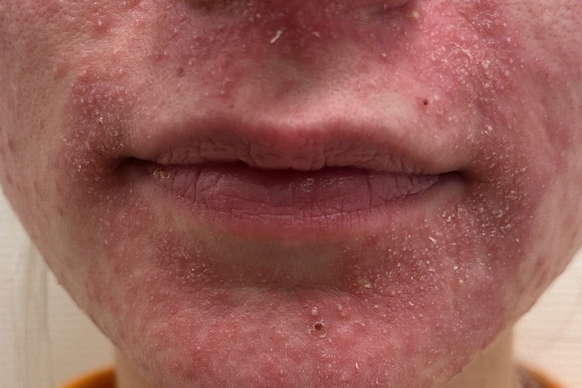 Perioralna dermatitis przed leczeniem