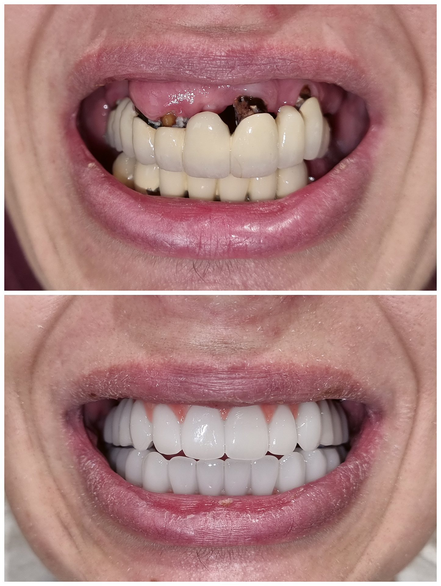 Dr. Ihde Dental AG Tratamiento antes y después