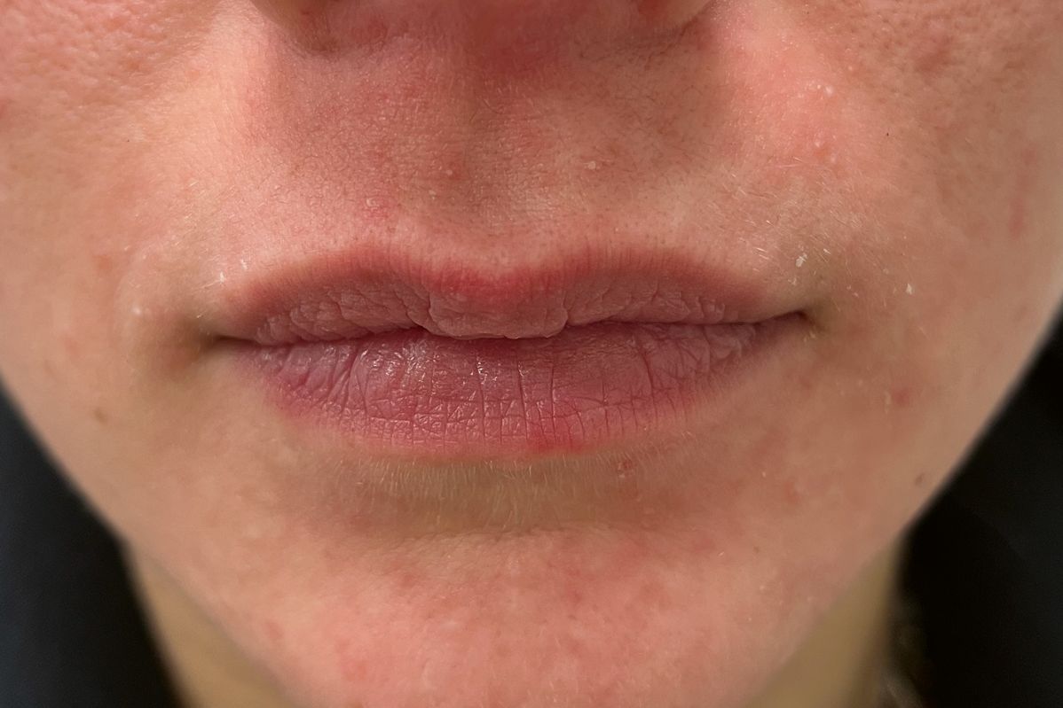 Dermatitis Perioralna po trzech sesjach z zimnym plazmą